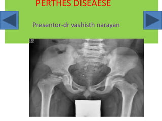 PERTHES DISEAESE
Presentor-dr vashisth narayan
 