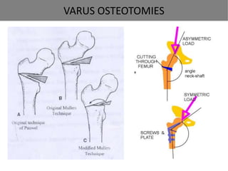 Varus Rotation Osteotomy Perthes disease | PPTX