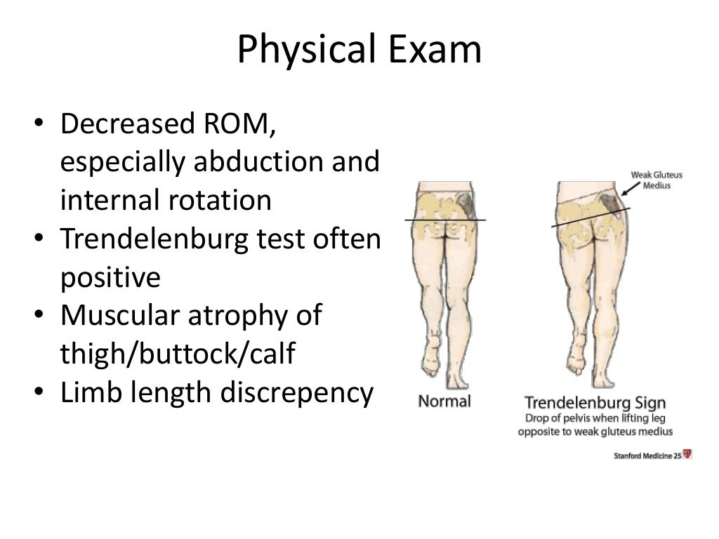 Perthes disease