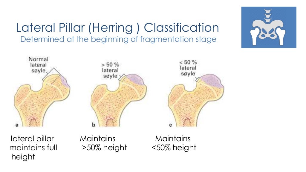 legg calve Perthes disease