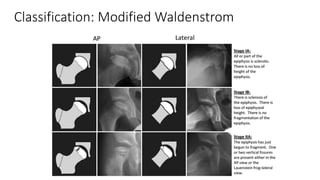 Classification: Modified Waldenstrom
 