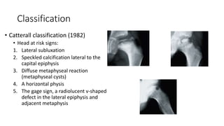 Classification
• Catterall classification (1982)
• Head at risk signs:
1. Lateral subluxation
2. Speckled calcification lateral to the
capital epiphysis
3. Diffuse metaphyseal reaction
(metaphyseal cysts)
4. A horizontal physis
5. The gage sign, a radiolucent v-shaped
defect in the lateral epiphysis and
adjacent metaphysis
 