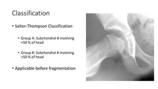 Classification
• Salter-Thompson Classification
• Group A: Subchondral # involving
<50 % of head
• Group B: Subchondral # involving
>50 % of head
• Applicable before fragmentation
 