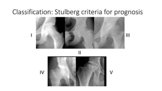 Classification: Stulberg criteria for prognosis
I
II
III
IV V
 