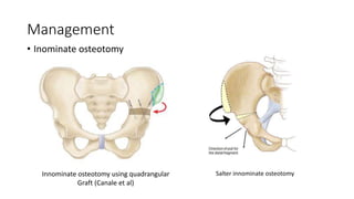 Management
• Inominate osteotomy
Innominate osteotomy using quadrangular
Graft (Canale et al)
Salter innominate osteotomy
 