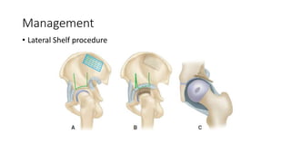 Management
• Lateral Shelf procedure
 