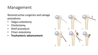 Management
Reconstructive surgeries and salvage
procedures
• Valgus osteotomy
• Cheilectomy
• Shelf procedure
• Chiari osteotomy
• Trochanteric advancement
 