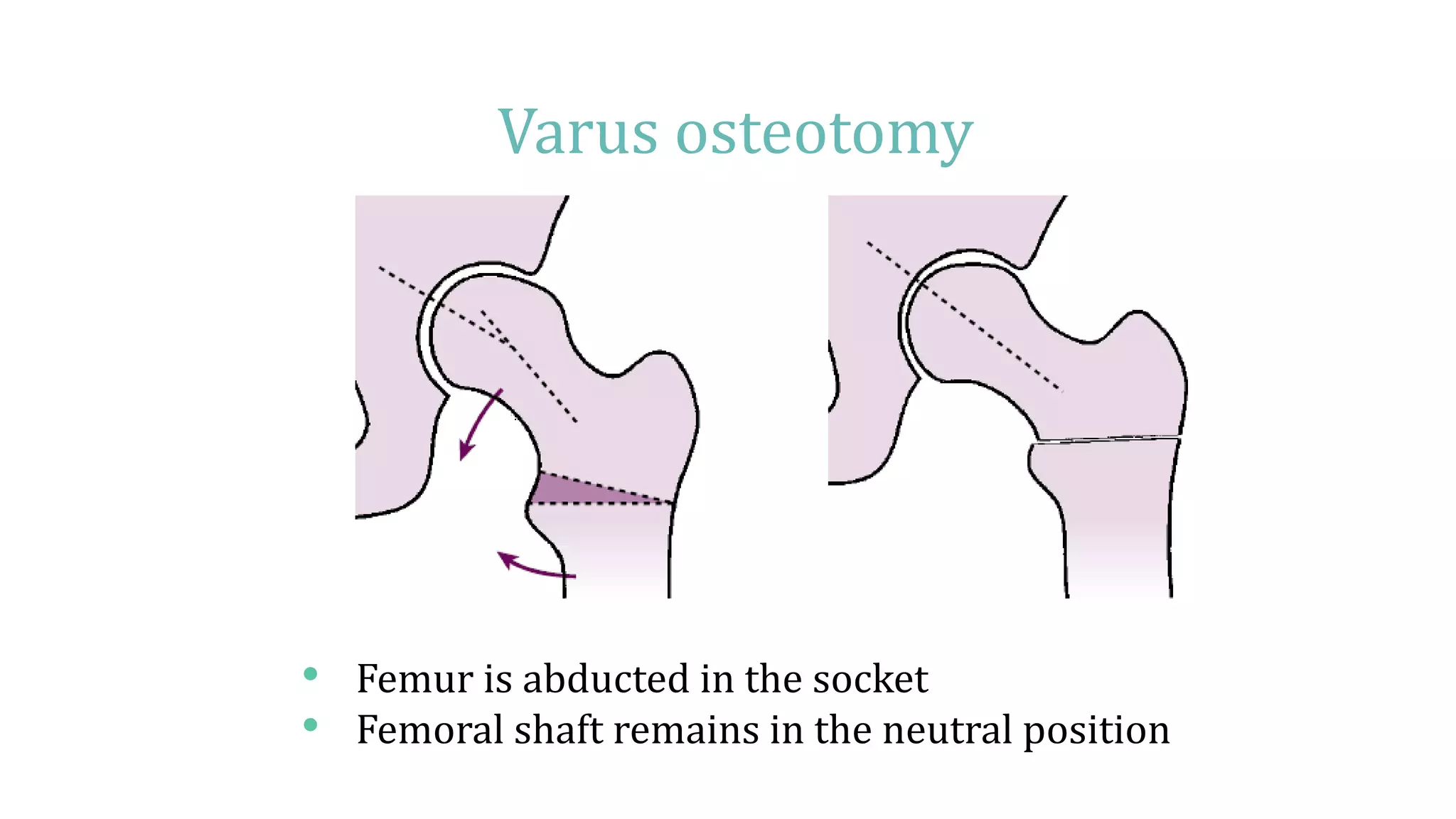 Legg Calve Perthes disease | PPTX