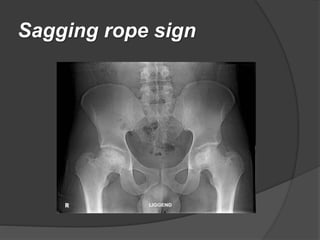 Perthes disease in children | PPTX