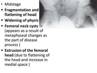 • Midstage
 Fragmentation and
flattening of head
 Widening of physis
 Femoral neck cysts
(appears as a result of
metaphyseal changes as
the part of disease
process )
 Extrusion of the femoral
head (due to flattening of
the head and increase in
medial space )
 