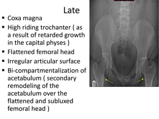 Late
 Coxa magna
 High riding trochanter ( as
a result of retarded growth
in the capital physes )
 Flattened femoral head
 Irregular articular surface
 Bi-compartmentalization of
acetabulum ( secondary
remodeling of the
acetabulum over the
flattened and subluxed
femoral head )
 