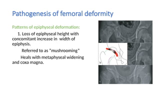 Perthes Disease Perthes Disease Perthes Disease .pptx