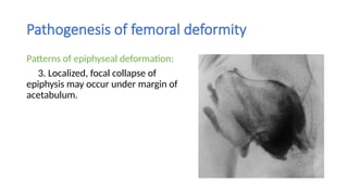 Perthes Disease Perthes Disease Perthes Disease .pptx