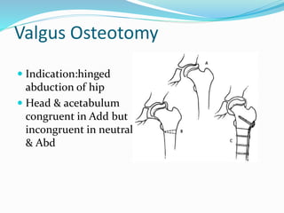Valgus Osteotomy
 Indication:hinged
abduction of hip
 Head & acetabulum
congruent in Add but
incongruent in neutral
& Abd
 