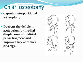 Chiari osteotomy
 Capsular interpositional
arthroplasty
 Deepens the deficient
acetabulum by medial
displacement of distal
pelvic fragment and
improves sup.lat.femoral
coverage.
 