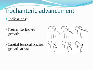 Trochanteric advancement
 Indications:
- Trochanteric over
growth
- Capital femoral physeal
growth arrest
 