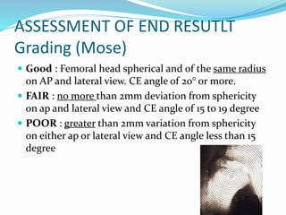 ASSESSMENT OF END RESUTLT
Grading (Mose)
 Good : Femoral head spherical and of the same radius
on AP and lateral view. CE angle of 20° or more.
 FAIR : no more than 2mm deviation from sphericity
on ap and lateral view and CE angle of 15 to 19 degree
 POOR : greater than 2mm variation from sphericity
on either ap or lateral view and CE angle less than 15
degree
 