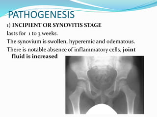 PATHOGENESIS
1) INCIPIENT OR SYNOVITIS STAGE
lasts for 1 to 3 weeks.
The synovium is swollen, hyperemic and odematous.
There is notable absence of inflammatory cells, joint
fluid is increased
 