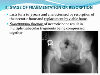 3) STAGE OF FRAGMENTATION OR RESORPTION
 Lasts for 2 to 3 years and characterised by resorption of
the necrotic bone and replacement by viable bone.
 Subchondral fracture of necrotic bone result in
multiple trabecular fragments being compressed
together
 