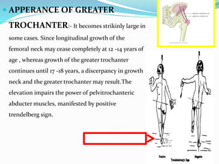  APPERANCE OF GREATER
TROCHANTER:- It becomes strikinly large in
some cases. Since longitudinal growth of the
femoral neck may cease completely at 12 -14 years of
age , whereas growth of the greater trochanter
continues until 17 -18 years, a discerpancy in growth
neck and the greater trochanter may result.The
elevation impairs the power of pelvitrochanteric
abducter muscles, manifested by positive
trendelberg sign.
 