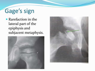 Gage’s sign
 Rarefaction in the
lateral part of the
epiphysis and
subjacent metaphysis.
 