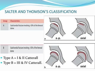 SALTER AND THOMSON’S CLASSIFICATION
 Type A = I & II Catterall
 Type B = III & IV Catterall.
 