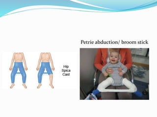 Petrie abduction/ broom stick
 