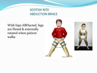 SCOTISH RITE
ABDUCTION BRACE
With hips ABDucted, legs
are flexed & externally
rotated when patient
walks
 