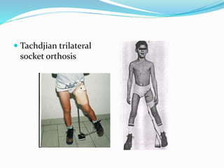  Tachdjian trilateral
socket orthosis
 