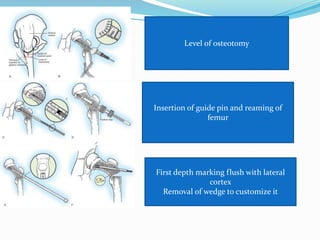 Level of osteotomy
Insertion of guide pin and reaming of
femur
First depth marking flush with lateral
cortex
Removal of wedge to customize it
 