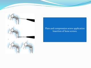 Plate and compression screw application
Insertion of bone screws.
 