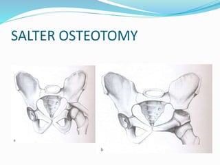 SALTER OSTEOTOMY
 