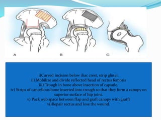 i)Curved incision below iliac crest, strip glutei.
ii) Mobilize and divide reflected head of rectus femoris
iii) Trough in bone above insertion of capsule.
iv) Strips of cancellous bone inserted into trough so that they form a canopy on
superior surface of hip joint.
v) Pack web space between flap and graft canopy with gratft
vi)Repair rectus and lose the wound.
 