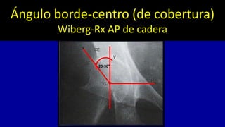 Enfermedad de Perthes/Pseudoartrosis del cuello femoral | PPTX