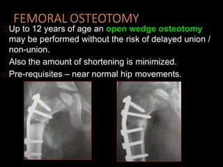 FEMORAL OSTEOTOMY
Up to 12 years of age an open wedge osteotomy
may be performed without the risk of delayed union /
non-union.
Also the amount of shortening is minimized.
Pre-requisites – near normal hip movements.
 