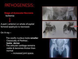 PATHOGENESIS:
Stage of Avascular Necrosis
Ischemia
A part ( anterior) or whole ofcapital
femoral epiphysis is necrosed.
On X-ray –
The ossific nucleus looks smaller
Classically of Perthes’,
looks dense
The articular cartilage remains
viable & becomes thicker than
normal
– increased joint space.
 