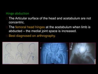 Hinge abduction
The Articular surface of the head and acetabulum are not
concentric.
The femoral head hinges at the acetabulum when limb is
abducted – the medial joint space is increased.
Best diagnosed on arthrography.
 