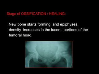 Stage of OSSIFICATION / HEALING:
New bone starts forming and epiphyseal
density increases in the lucent portions of the
femoral head.
 