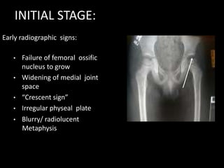 Early radiographic signs:
• Failure of femoral ossific
nucleus to grow
• Widening of medial joint
space
• “Crescent sign”
• Irregular physeal plate
• Blurry/ radiolucent
Metaphysis
INITIAL STAGE:
 