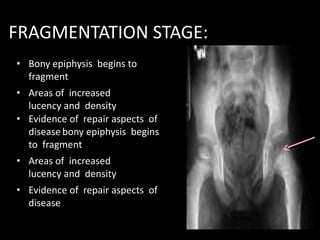 • Bony epiphysis begins to
fragment
• Areas of increased
lucency and density
• Evidence of repair aspects of
disease bony epiphysis begins
to fragment
• Areas of increased
lucency and density
• Evidence of repair aspects of
disease
FRAGMENTATION STAGE:
 