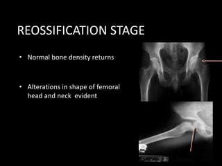 • Normal bone density returns
• Alterations in shape of femoral
head and neck evident
REOSSIFICATION STAGE
 