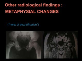 ill(1(“holes of decalcification”)
 