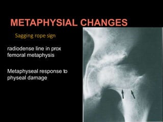 Sagging rope sign
radiodense line in prox
femoral metaphysis
Metaphyseal response to
physeal damage
 