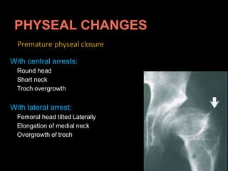 Premature physeal closure
With central arrests:
Round head
Short neck
Troch overgrowth
With lateral arrest:
Femoral head tilted Laterally
Elongation of medial neck
Overgrowth of troch
 