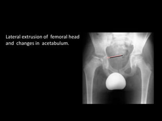 Lateral extrusion of femoral head
and changes in acetabulum.
 
