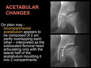 On plain xray -
bicompartmental
acetabulum appears to
be composed of 2 arc
partly overlapping each
other – interpreted as the
subluxated femoral head
articulating only with the
lateral half of the
acetabulum moulding it
into 2 compartments
 