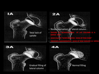 • Revascularisation at lateral column
• FAILURE TO REVASCULARISE AT LAT COLUMN IS A
GRAVE SIGN
• ALSO CALLED “SCINTIGRAPHIC HEAD AT RISK SIGN”
• PRECEDES RADIOGRAPHIC HEAD AT RISK SIGN BY 2-3 MTHS
Total lack of
uptake
Normal filling
Gradual filling of
lateral column
 