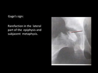 Rarefaction in the lateral
part of the epiphysis and
subjacent metaphysis.
Gage’s sign:
 