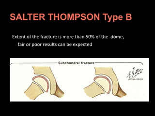 Extent of the fracture is more than 50% of the dome,
fair or poor results can be expected
 