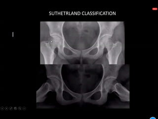 SUTHETRLAND CLASSIFICATION
 